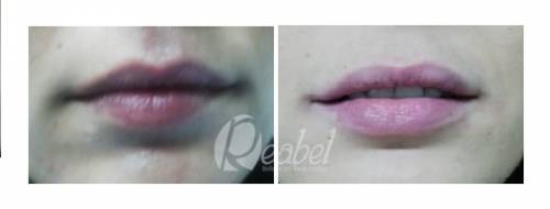 ASIMETRIA EN LABIOS